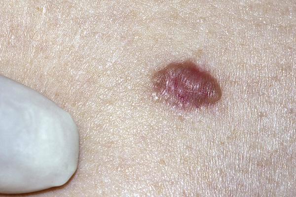 skin cancer and basal cell carcinoma