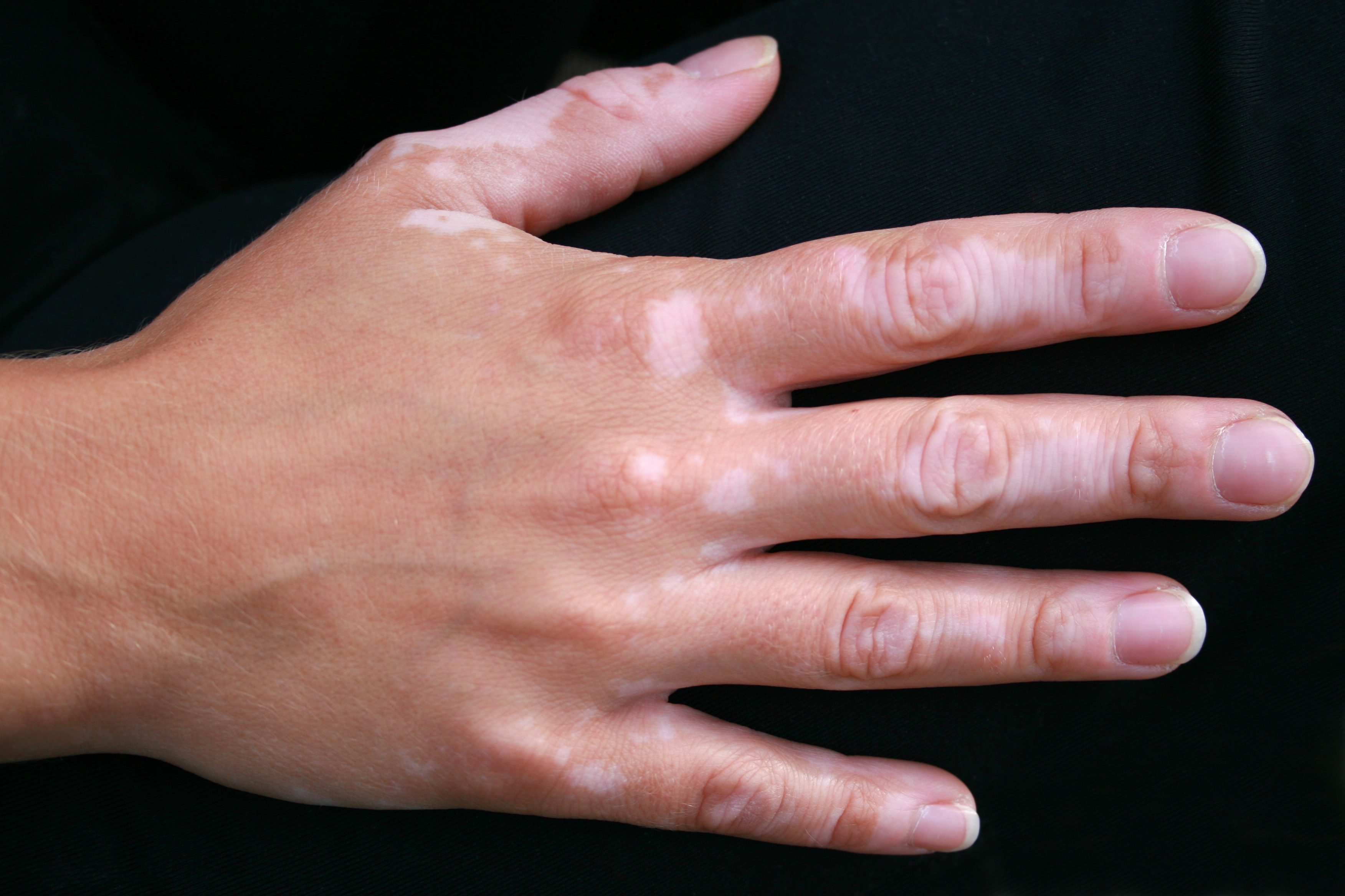 Hand with Vitiligo Skin Condition 